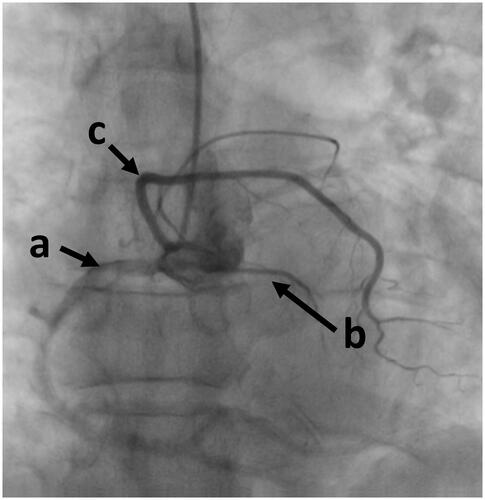 Figure 4. Coronary angiography showing dominant right coronary artery (a) and its two branches: the first vessel (b), the second one (c).
