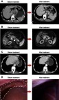 Figure 3 Assessment of tumor response to preoperative chemotherapy using computed tomography, magnetic resonance diffusion-weighted imaging, or laparoscopy. White dotted lines represent the range of metastasis lesions.Abbreviations: L, left; R, right.