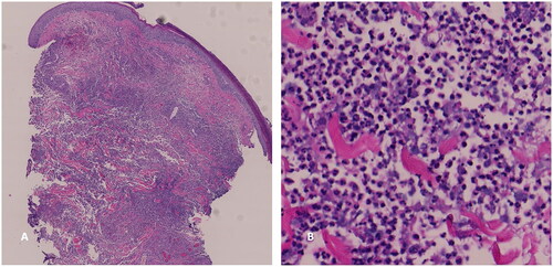 Figure 2. Punch biopsy of ulcer edge. Hematoxylin and eosin stain demonstrating exuberant neutrophilic inflammation in the dermis (A) 20× (B) 200×.