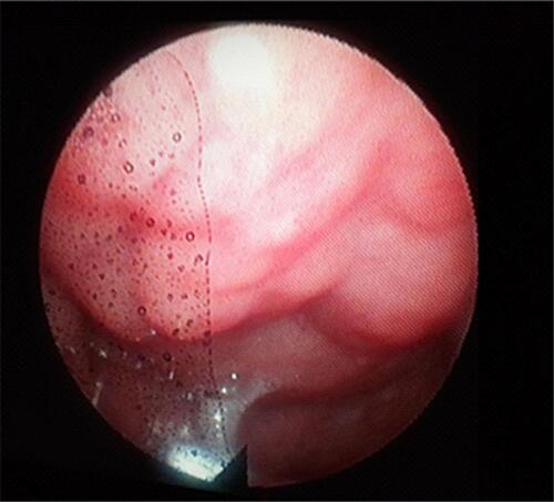 Figure 2 Hypertrophy of the pharyngeal tonsil registered using a flexible endoscope and EndoSTROB EL videostroboscope f. Xion.