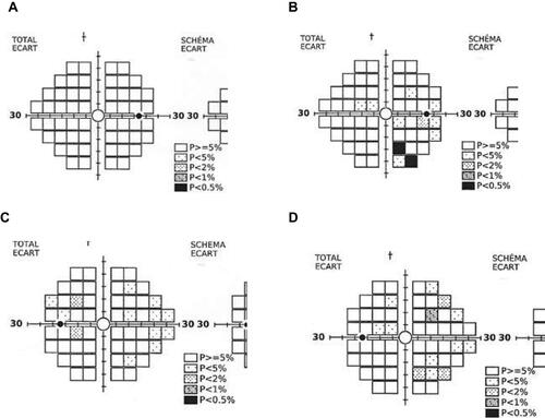 Figure 6 (A–D) Evolution of the visual field defects. (A) Patient A OD year 1- no defect; (B) patient A OD year 2- defect in 3 quadrants; (C) patient B OS year 1 - defect in 4 quadrants; (D) patient B OS year 2 – defect in 3/4 quadrants but more severe.