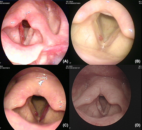 Figure 1. Endoscopic image of the vocal folds. A) Diffuse hemorrhage is shown in the right vocal fold. B) A hemorrhagic polyp is shown in the right vocal fold. C) A hemorrhagic polyp in the right vocal fold and diffuse ecchymosis in the left vocal fold are shown. D) Healthy vocal folds are shown after laryngomicrosurgery and CO2 laser ablation.
