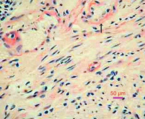 Figure 3 Rectum biopsy: amyloid deposits are confirmed by a positive Congo red stain (arrow), which gives the characteristic salmon pink color (200×).