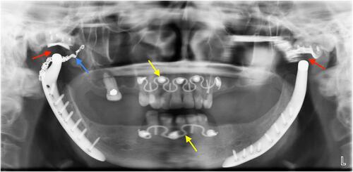 Figure 2 A post-operative panoramic after the patient underwent a series of three separate surgeries to correct her right mandibular bony ankylosis and previously placed failed left TMJ prosthesis. This radiograph depicts bilateral custom-made total TMJ prosthetic implants (TMJ Implants, Ventura, CA). The gaps between the prosthetic condyle and glenoid fossa plate (red arrows) represent the plastic insert on which the metallic condyle articulates. The embolization coil of the right maxillary artery is seen underlying the reconstructed TMJ (blue arrow). Temporary intermaxillary fixation wires are secured with screws (yellow arrows).