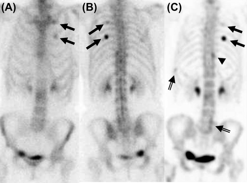 Figure 3. 99mTc-hydroxymethane diphosphonate bone scintigraphy, anterior (A) and posterior view (B), and SPECT (C) of 62-year-old breast cancer patient with elevated alkaline phosphatase and localized pain in upper back. Lesions in the 5th and 7th rib (marked by black arrows) on the left side are highly suspicions of being bone metastases based on bone scintigraphy and SPECT. The lesions (marked by half filled arrows) in the fifth lumbal vertebra and 9th rib on the left side were considered as equivocal on prospective SPECT reading while the increased uptake (marked by black arrowhead) in the left side of thoracic spine at the level of X was considered as a benign uptake on prospective SPECT reading.