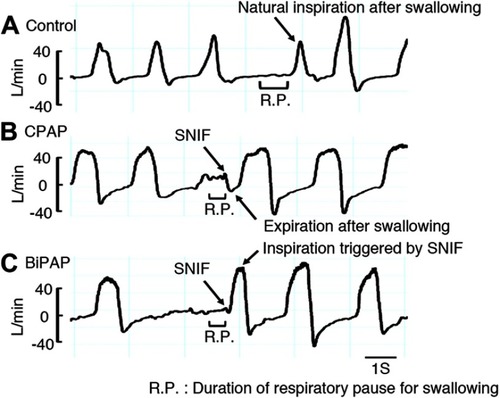 Figure 2 Representative respiratory flow signals during saliva swallowing under (A) control, (B) CPAP, and (C) BiPAP conditions. Note that inspiration after swallowing under the control condition is a natural inspiration, whereas inspiration after swallowing under the BiPAP condition is triggered by SNIF. Abbreviations: SNIF, the occurrence of swallowing-associated non-inspiratory flow; CPAP, continuous positive pressure ventilation; BiPAP, bi-level positive airway pressure ventilation.