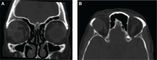 Figure 1 Orbital computed tomography.