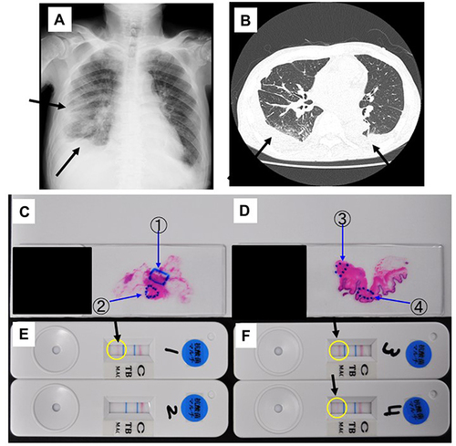 Figure 2 Chest X-ray/ computed tomography (CT) findings and detection of the genes of Mycobacterium avium complex by tissue-direct polymerase chain reaction-based nucleic acid lateral flow immunoassay (tdPCR-NALFIA) from skin tissue in patient 2. (A and B): Chest X-ray findings (A) and CT findings (B) of patient 2, respectively. Arrows indicated infiltration shadows and pleural effusions. (C–F): Mycobacterium avium complex detection in the patient’s skin tissue section and tdPCR-NALFIA, respectively. The images show the granulomas (C and D) and the detected bands (E and F), respectively (arrows). The numbers indicate the selected tissue and the results of tdPCR-NALFIA for each selected tissue.