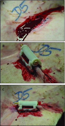 Figure 1.  Complex groin injury and application of treatment. (A) A complex and lethal groin injury was created by complete excision of a 2- to 3-cm section of the femoral artery and vein below the inguinal ligament. (B, C) Approximation of the wound edges with ITClamp seals the skin within the pressure bars of the device.