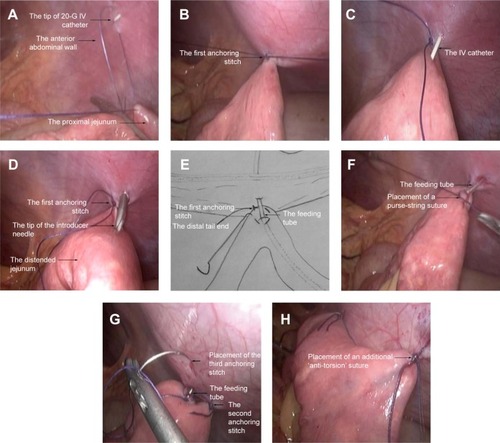 Figure 3 Demonstration of the modified laparoscopic needle catheter jejunostomy.