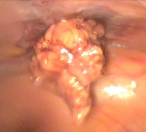 Figure 6 Removal of the IUD from the abdominal cavity.