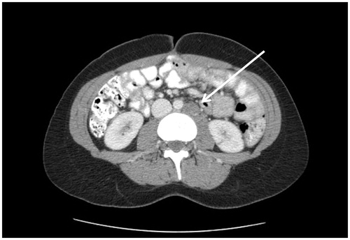 Figure 6. CT slice showing para-aortic lymphadenopathy.