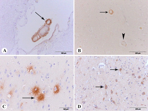 Figure 3 (A) β-amyloid deposits in the wall of meningeal blood vessels (arrow), anti-Aβ1-42, frontal section; (B) β-amyloid deposits in the wall of parenchymal blood vessels (arrow – severe type of the Vonsattel scale and score 4 of the Mountjoy scale, arrowhead – mild type of the Vonsattel scale and score 1 of the Mountjoy scale), anti-Aβ 1-14, frontal section; (C) diffuse plaque (arrow), anti-Aβ 1-42 parietal section; (D) intracellular β-amyloid deposits (arrow), anti-Aβ 1-14, parietal section.