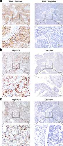 Figure 2. Expression of PD-L1/PD-1/CD8 in locally advanced UTUC. (a) Representative images of immunohistochemical detection of PD-L1 (brown) in tumor cells (TCs). (b, c) Representative images of immunohistochemical detection of CD8+ lymphocytes and PD-1+ lymphocytes (brown). (scale bar, 100 μm for upper rows, 25 μm for lower rows). Programed death-1 = PD-1, Programed death-ligand 1 = PD-L1