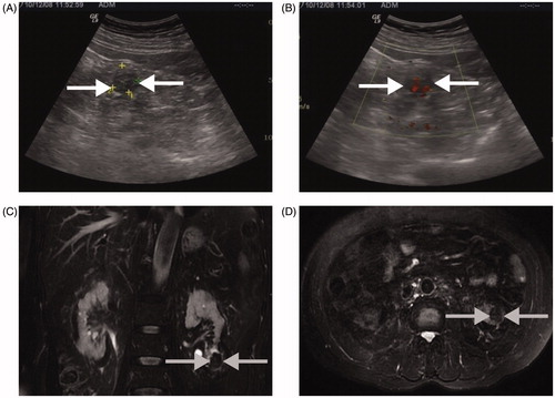Figure 3. A 2.5 × 2.5 cm tumour lesion in the left kidney of a 76-year-old man treated with MWA. (A and B) A right kidney tumour is detected by conventional US at physical check-up (white arrow); (C and D) Five years after MWA MR image shows no recurrent tumour in the ablation zone (grey arrow).