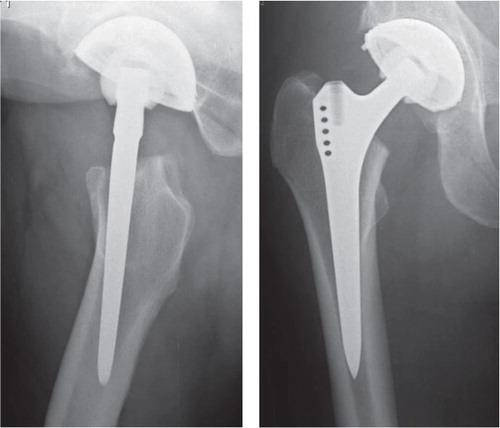 Figure 8. Postoperative radiographs of the stem that later became loose.