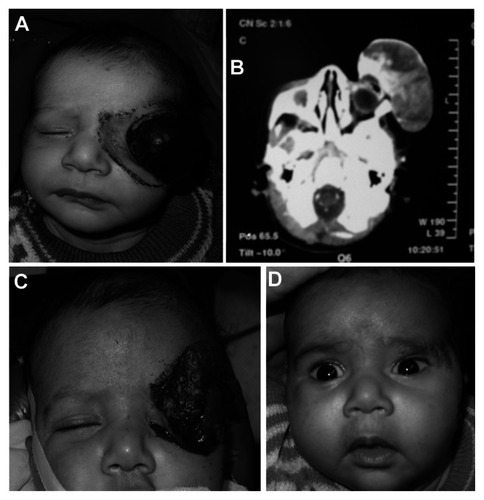 Figure 1 (A) Two-month-old boy presenting with a huge “tennis ball” hemangioma with (B) computed tomography scan showing no orbital extension. (C) Three days after parenteral steroids showing a marked decrease in size with sloughing of the overlying skin. (D) Two weeks after surgical removal.