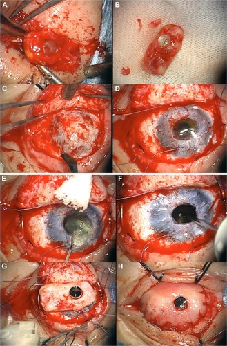 Figure 9 OOKP stage 2 – retrieval of the lamina and implantation into the eye.