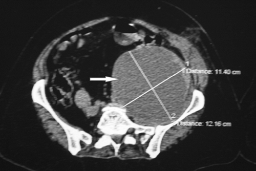 Figure 1: The contrast-enhanced computed tomography scan demonstrates a large area of low attenuation involving the left iliopsoas muscle (arrow)