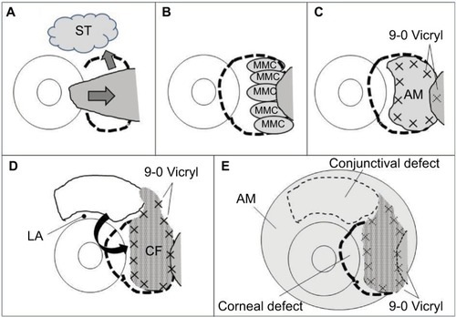 Figure 1 Surgical procedure.