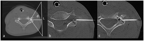 Figure 5. (a) Axial CT image showing an 8-mm OO in the left pedicle of C4. The vertical white line (L = 100 mm) represents optimal transducer placement. The white line (d = 30 mm) corresponds to the depth of the OO. In this case, cooling of the C5 foraminal space is mandatory but impossible due to transducer bulk. This case was considered ineligible for HIFU (group (c)). (b, c) Axial CT image demonstrating ablation: an 18-gauge spinal needle with a coaxially inserted thermocouple for temperature monitoring was positioned in the C4–C5 foramen, in contact with the C5 nerve root (b, arrow). The laser fiber was then inserted coaxially in an 18-gauge needle, with the tip in the center of the nidus (c, arrow).