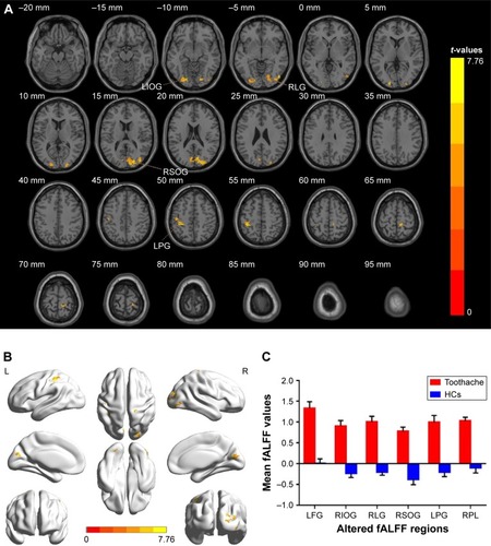 Figure 1 Spontaneous brain activity in patients with toothache and HCs.