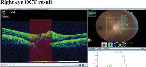 Figure 1. Optical coherence tomography for the right and left eye
