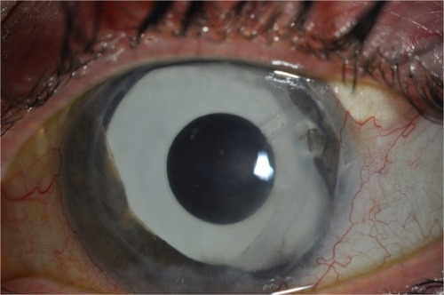 Figure 4 A patient who has undergone multiple procedures for iridocorneal endothelial syndrome. A clear Descemet stripping automated endothelial keratoplasty graft is visible, with a supertemporal Baerveldt tube in situ. A prosthetic iris implant can also be seen.