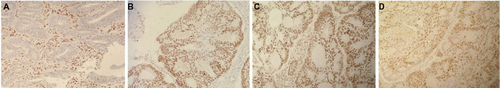 Figure 2 Colorectal adenocarcinoma showing loss of PMS2 (A). The PMS2 proteins are expressed in the proliferating stromal cells. The MLH1 (B), MSH2 (C), and MSH6 (D) are expressed in the tumor cells and the stromal cells. Cases from Instituto de Patologia Mejia Jimenez, Cali, Colombia.