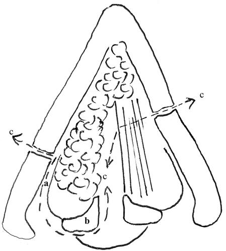 Figure 1 Limits of the resection. (a) Paraglottic space. (b) Arytenoid cartilage. (c) Excision planes.