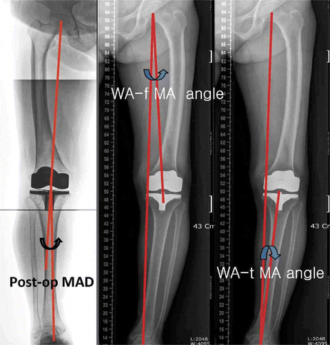 Figure 2. Full-length weight-bearing AP radiographs showing the measurement of postoperative parameters: the postoperative mechanical axis difference (MAD) and differences between the weight-bearing mechanical axis of the lower limb (WA) and the mechanical axes of the femur (f WA) and tibia (tWA) separately (WA-f MA, WA-t MA, respectively).