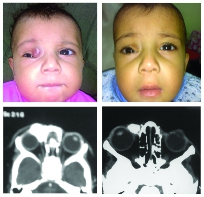 Figure 3 A right upper-lid hemangioma prior to and 3 months after propranolol hydrochloride administration with an evident decrease in size as shown by the axial computed tomography scan with enhancement.