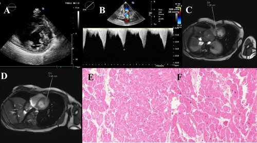 Figure 1. Heart imaging picture. A, B. Echocardiography revealed that the left anterior ventricular wall was mainly hypertrophy. C, D. MRI showed that the anterior wall thickness of the basal segment of the left ventricle was 14.8 mm, and the thickness of the interventricular septum was 12.6 mm. The anterior and inferior walls of the left ventricle are thickened asymmetrically. E, F. Pathological tissue biopsy revealed hypertrophy of myocardial cells, multifocal fibrous hyperplasia in the myocardium, and a small amount of adipose tissue.