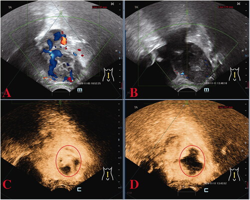 Figure 2. Preoperative and post-operative ultrasound assessment of HIFU therapy in the first case. Preoperative ultrasound localization: abnormal echogenicity on the right lateral wall of the uterus with bar-like blood flow signals detected (A), immediate post-operative image (B) showing reduced blood supply in the lesion; the CEUS image before (C) and after (D) HIFU therapy revealing that the non-perfusion region has filled the treatment area of the lesion, indicating a good ablation effect. CEUS, contrast-enhanced ultrasound; HIFU, high-intensity focused ultrasound