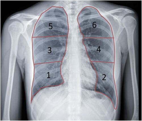 Figure 1 Lung field division using Modified Chest X-ray Scoring System on chest posteroanterior (PA) projection, The lung field is divided into six zones lower zone (1 or 2) is under the inferior wall of the lower right pulmonary vein (lung base), middle zones (3 or 4) is below the inferior wall of the aortic arch and above the inferior wall of the lower right pulmonary vein (ie, hilar structures), and upper zone (5 or 6) is above the inferior wall of the aortic arch.