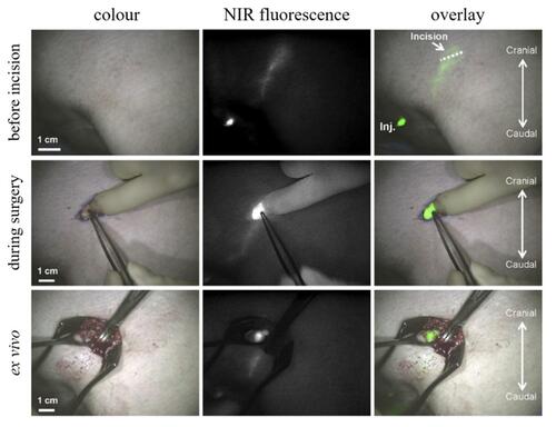 Figure 8 Real-time in situ NIR fluorescence imaging with ICG as the contrast agent of sentinel lymph nodes in vulvar cancer patients. Reproduced from Sentinel lymph node biopsy in vulvar cancer using combined radioactive and fluorescence guidance. Verbeek FPR, Tummers QRJG, Rietbergen DDD, et al. Int J Gynecol Cancer. 25:1086–1093. Copyright (2015), with permission from BMJ Publishing Gorup Ltd.Citation124