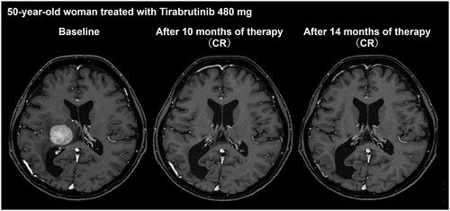 Figure 3. MRI image of patient who responded to BTK inhibitors (tirabrutinib, ONO-4059-02 trial) in PCNSL.MRI: magnetic resonance imaging; PCNSL: primary central nervous system lymphoma.