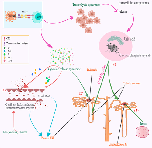 Figure 2 Proposed major mechanisms of nephrotoxicity in bispecific antibodies (BsAbs) recipients. 1) Cytokine release syndrome with excessive cytokines will function on blood vessels and cause cytokine-driven capillary leak syndrome as well as intravascular volume depletion, which can lead to hypotension and induce prerenal acute kidney injury (AKI) or transient creatinine increased. 2) Excessive cytokines will infiltrate, attack glomerulus tissue, destroy the filtration barrier, and finally induce proteinuria. 3) Too much or too fast lysis of cancer cells will produce excessive calcium salts, phosphate, and uric acid. The accumulation of uric acid, calcium, and phosphate cause the formation of crystals in the kidney tubules, blocking the kidney tubules, inducing infection, and finally leading to tubules necrosis. 4) Under the infection situation, sepsis may be a risk factor of glomerulonephritis.