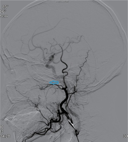 Figure 2 Post-embolization internal maxillary artery angiograms revealing total occlusion of the artery (indicated by the arrow).