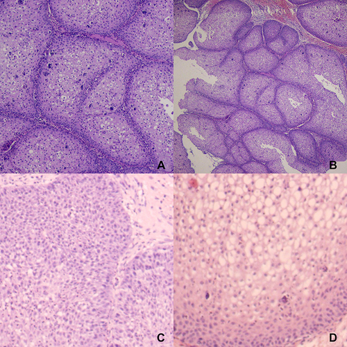 Figure 4 (A) (HE staining, ×10) and (B) (HE staining, ×5) are the first postoperative images revealing a Schneiderian papilloma; (C) (HE staining, ×10) and (D) (HE staining, ×20) are the second postoperative images revealing a Schneiderian papilloma that exhibited papilloma-like hyperplasia.