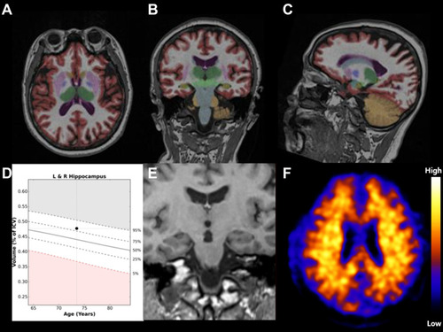 Figure 1 Representative 73-year-old woman with MCI. (A–C): Output from analysis with NeuroQuant shows segmentation of regional brain volumes.(D): Age-matched reference chart provided by NeuroQuantshowing the % of ICV and normative percentiles of hippocampal volume are 0.48 and 81, respectively. The prediction score calculated from age and hippocampal % of ICV was −13.16. The normative percentile of the hippocampus was 28.(E): Coronal T1-weighted MR image shows no hippocampal atrophy.(F): Negative amyloid imaging scans with “low” Pittsburgh compound B retention.