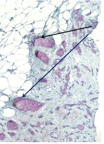 Figure 9 Duct-invasive breast carcinoma with R/C-positive tumor cell nests (arrows). The staining is not as strong as in the FDOJ samples.