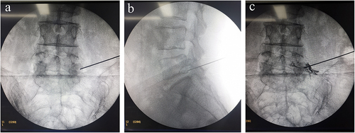 Figure 1 A 67-year-old man presented with radicular pain on the left side. Selective nerve root block (SNRB) was performed on the left side of the L5-S1 level to determine the responsible segment. (a and b) The location of SNRB injection site. The 8G needle was stopped under the lateral edge of the pedicle just above the target foramen. The needle tip should not go beyond the midportion of the pedicle in an anteroposterior view. (c) 0.5 mL of contrast medium was injected to determine the contrast medium’s distribution and ensure it is limited around the target foramen.