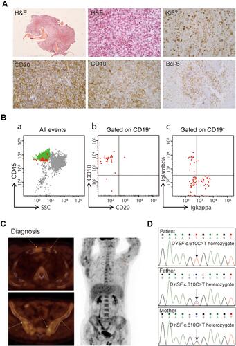 Figure 1 Hematopathology results of a progressive muscular dystrophy patient with diffuse large B-cell lymphoma. (A) Hematoxylin and eosin (H&E) and immunohistochemistry staining of bone biopsy samples. (B) Flow cytometry analysis of bone marrow aspirates at diagnosis. (C) Computed tomography and positron emission tomography images at diagnosis. (D) Confirmation of the peripheral blood DYSF c.610 C>T mutation in this patient and his parents using Sanger sequencing.