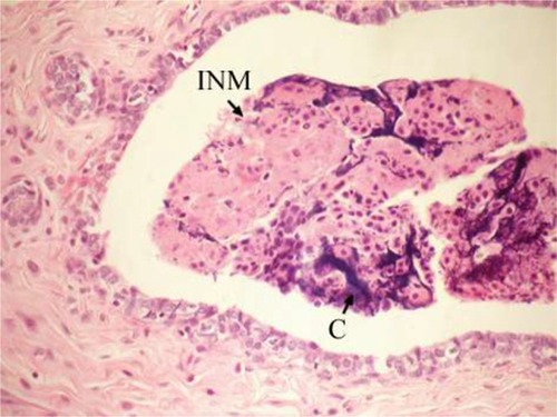 Figure 7 Photomicrograph of breast section of DMBA-administered control rat showing hyperplasia of ductal epithelial lining with INM and calcifications (C) (H and E, ×400).