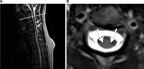 Figure 2 Sagittal (A) and axial (B) T2W-weighted MRI at 6-month follow-up revealing subtotal remission of the posterior columns’ signal alterations.