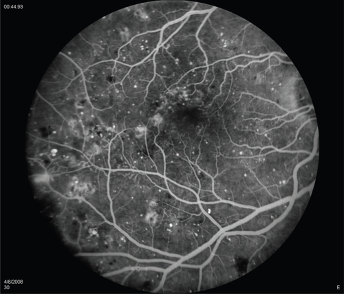 Figure 2c Fluorescein angiography of a macula exhibiting diabetic macular edema. The retinal vascular arcades are visible along with scattered areas of hyperfluorescence throughout the macula, indicating leakage of fluid due to diabetes-induced vascular incompetence.