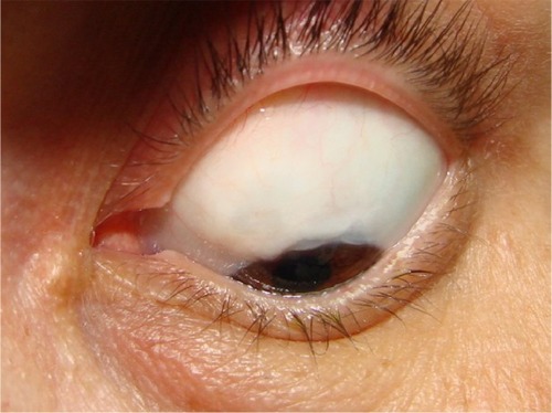 Figure 10 Functioning bleb of a group B patient (mitomycin C only) late postoperatively.