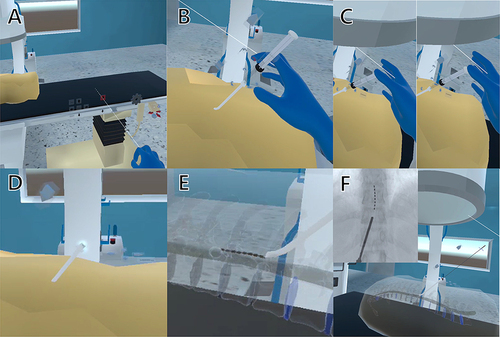 Figure 2 Configuration for a spinal stimulation simulation. (A) Adjusting the bed position using the light beam from the right hand. (B) Fine adjustment of the needle entering the skin by touching the arrows around the needle. (C) When the tip of the syringe is lightly pressed with the thumb, the syringe goes in (left) and out (right) along the thumb. (D) Cerebrospinal fluid leaking when the needle punctures the dura. (E) The lead travelling along the virtual spinal cord in the epidural space. (F) Positional relationships of the actual anatomical structures can be identified using x-ray images by making the skin and bones transparent.