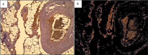 Figure 15. Breast tissue H&E stained section. a) H & E stained image; b) Specified colour range ‘reddish brown’ is separated out